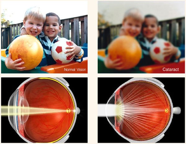 Как происходит амбулаторное удаление катаракты?