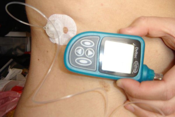 В Запорожье детям с сахарным диабетом вручили инсулиновые помпы