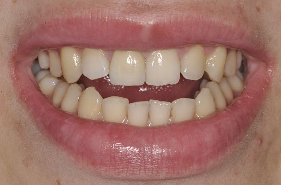 Восстановление зубов винирами. Основные моменты