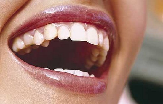 Зубной камень: как лечить